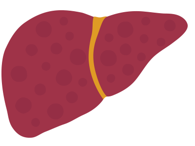 Icon of liver with mild fibrosis stage F1